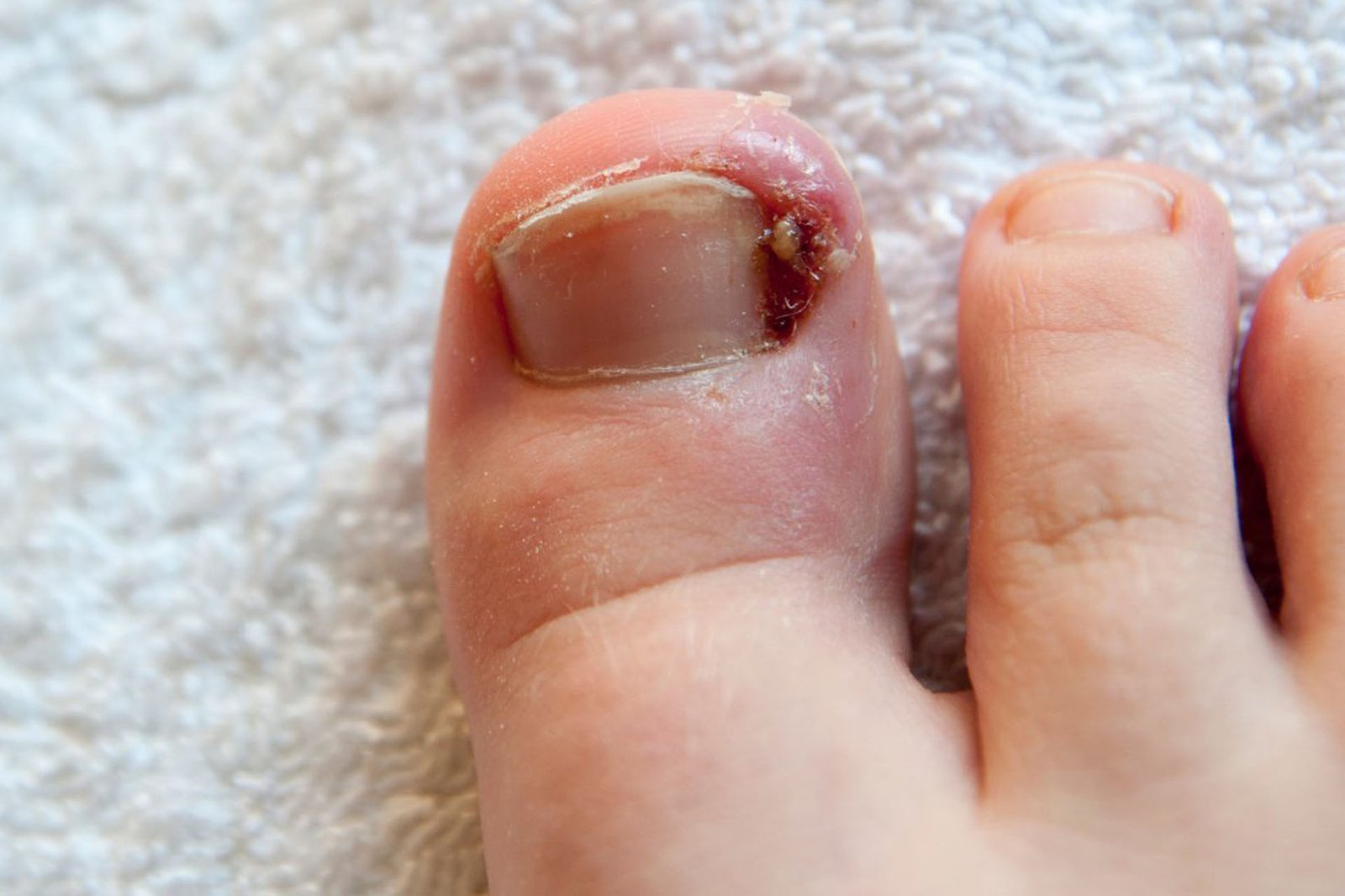 Onyfix | Non-Surgical Treatment for Ingrown Toenails in Mullaloo